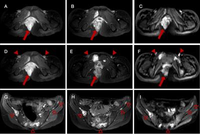 Primary perianal alveolar rhabdomyosarcoma with uncommon metastatic sites: a case report and follow-up using 18F-FDG PET/CT